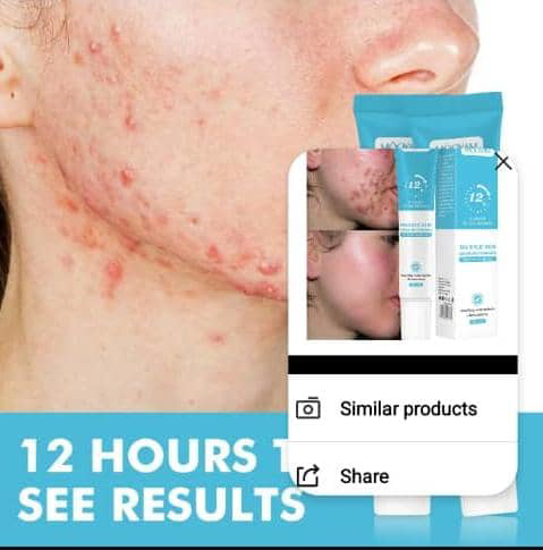 Image sur Gel visage anti-acné MOOYAM – Efficace dès 12h – Antitaches –Élimination points noirs – Garantie 6 mois